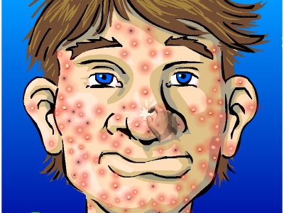 acne.png